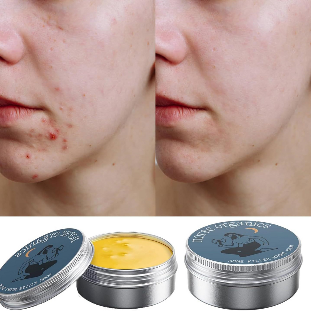Acne Treatment & Muscle Joint Relief Cream – 2-in-1 Targeted Skin & Pain Relief