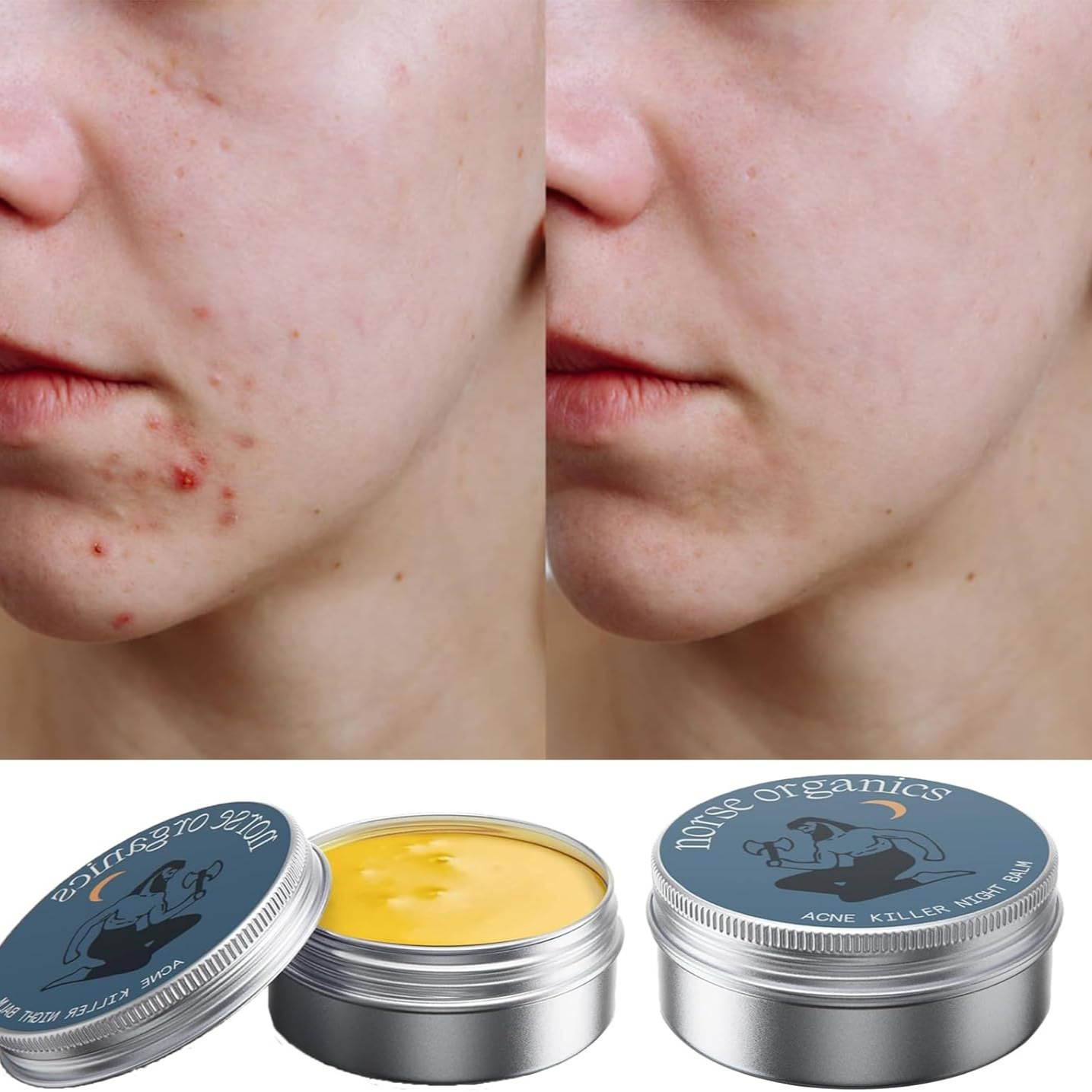 Acne Treatment & Muscle Joint Relief Cream – 2-in-1 Targeted Skin & Pain Relief